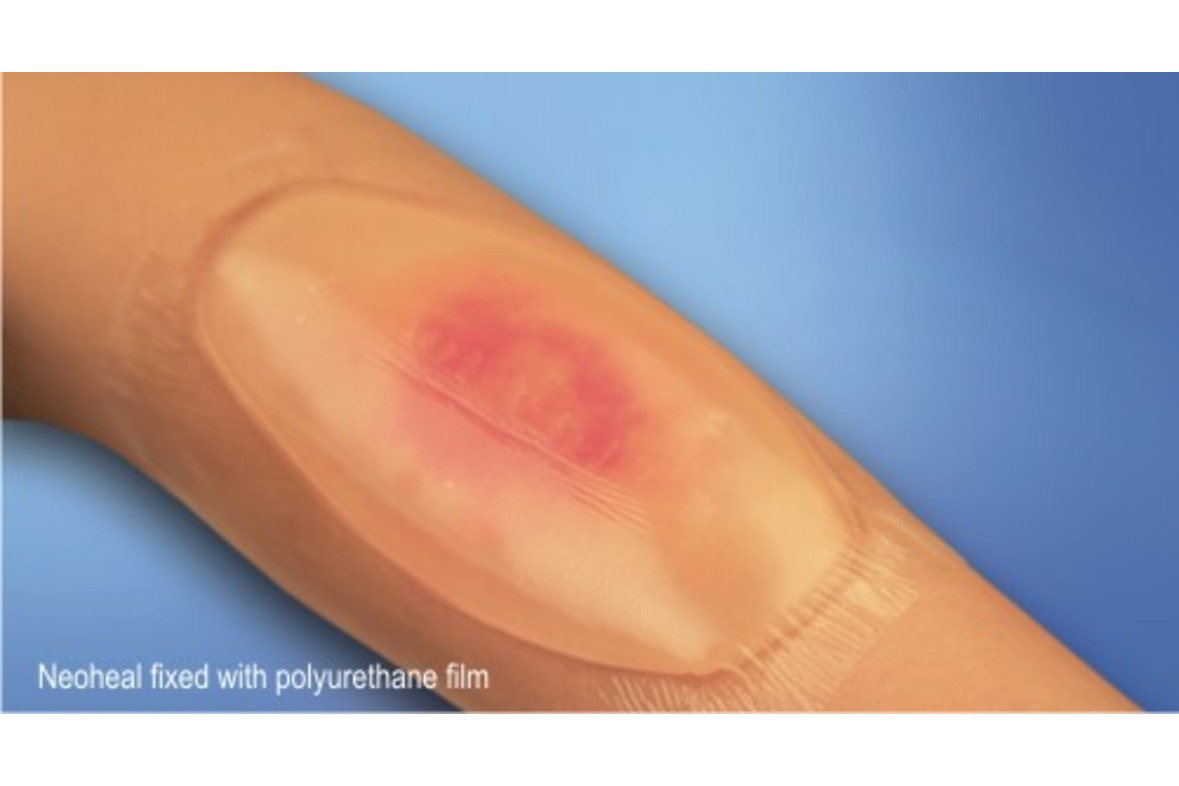 Hydrogel-Wundauflage NEOHEAL rund